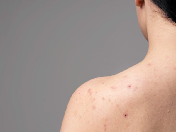 Granos en la espalda: por qué salen y cómo prevenirlos